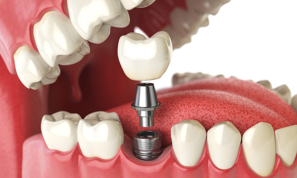 Dental Implants In Pune